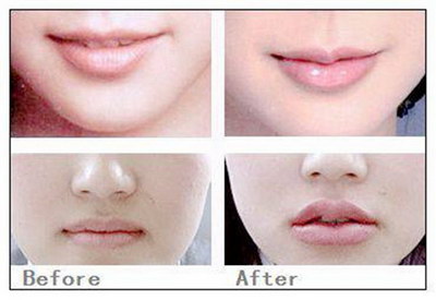 玻尿酸丰唇的效果是否持久？