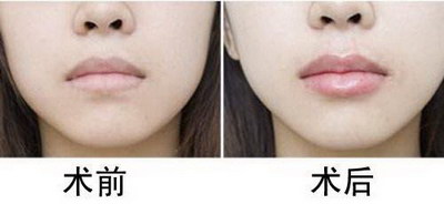 玻尿酸丰唇多少钱丰唇具有如何的效果呢？