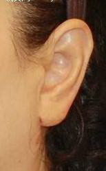 耳软骨和肋软骨哪个吸收率高(耳软骨和肋软骨吸收率)