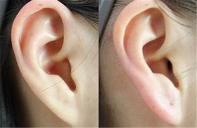 耳朵边上的皱纹怎么能去掉