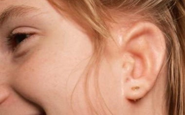 耳朵置管手术(耳朵置管手术怎么做)