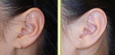 修复耳朵多少钱啊_修复耳朵需要多少钱啊
