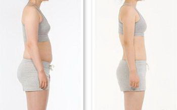 自体脂肪臀部整形有哪些方法_自体脂肪臀部塑形流程