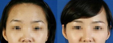 全脸脂肪胶填充几天消肿(1)_如何利用全脸脂肪填充实现更好的化妆效果?