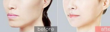 医用透明质酸钠修复贴用完洗脸吗