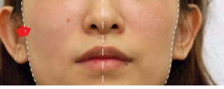 怎么区分敏感肌和激素脸_排除激素脸的最好方法