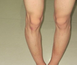 o型腿是怎么遗传的(o型腿怎么形成的是遗传吗)