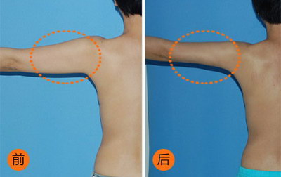 瘦肩针副作用及功效