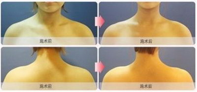 如何减少颈肩部位肌肉(如何减少颈肩部位肌肉)