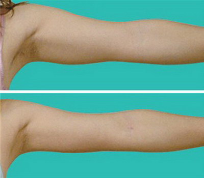 手臂吸脂减肥手术有几个_手臂吸脂减肥费用