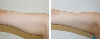 用抽吸脂肪的方法瘦手臂的效果好不好？