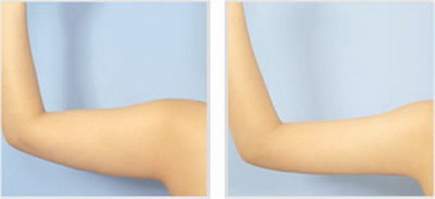 瘦手臂最有效的方法图解「瘦手臂有效的方法图解」