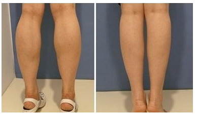瘦腿的方法有哪些暴瘦的_瘦腿方法有哪些