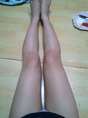 吸脂瘦腿效果如何_吸脂瘦腿的效果如何