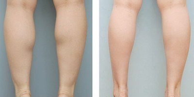 大腿抽脂能抽多少出来_大腿抽脂疼痛是什么原因