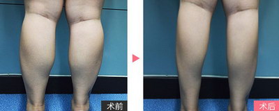 女生怎样瘦大腿和肚子(瘦大腿和肚子的方法)