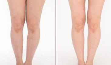 提升臀部下垂：大腿吸脂的益处
