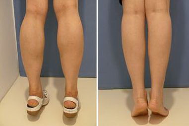 臀部和大腿抽脂手术可以一起做吗(臀部和大腿抽脂手术多久可以洗澡)