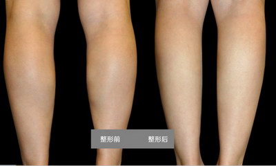 针灸减大腿效果怎么样_怎样的运动可以减大腿和肚子