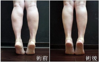 刷腿真的可以瘦腿么有副作用吗_公认的瘦腿最有效的3个小动作