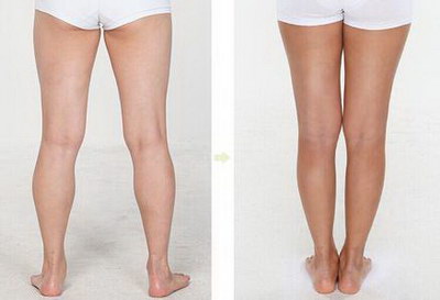 如何改变大粗腿成为小细腿呢？