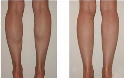 大腿抽脂第十天肿胀怎么回事_大腿抽脂效果图对比