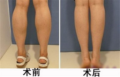简单有效的瘦腿方法有哪些_瘦腿最有效最简单的方法