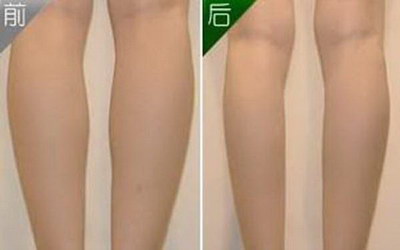 腿部吸脂后的肿胀期:如何正确应对_腿部吸脂后会变漂亮吗