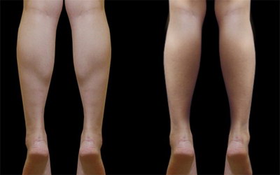 遗传的粗腿能瘦吗