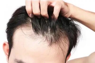 吃什么可以增加发量防脱发_克洛特洗发水真的防脱发吗