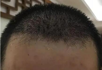 脱发3个月多久能恢复(脱发问题：3个月后该如何恢复)