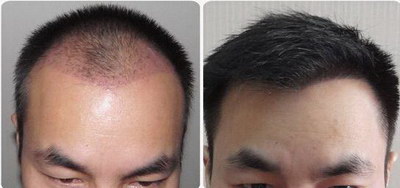 脂溢性脱发的原因及治疗方法
