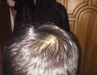 防止脱发的最佳方法_染发导致的脱发