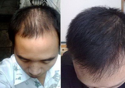 脱发的治疗方法及药物_益脂脱发的治疗方法