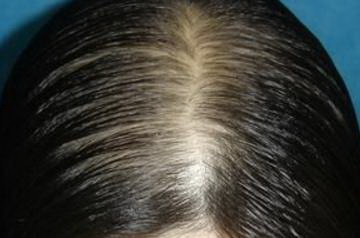 脱发能恢复以前的发量吗(脂溢性女性脱发能恢复到以前的发量吗)