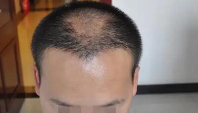 脂溢性脱发植发有效果吗(脂溢性脱发和植发介绍)
