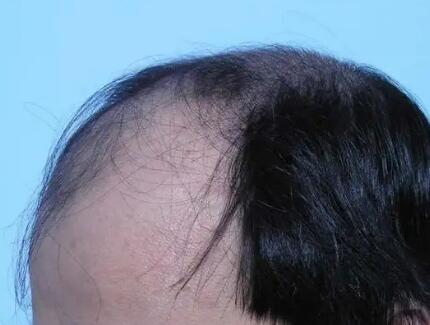 脂溢性脱发能用护发素吗(什么是脂溢性脱发？)