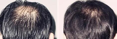 脱发的过程有几个阶段