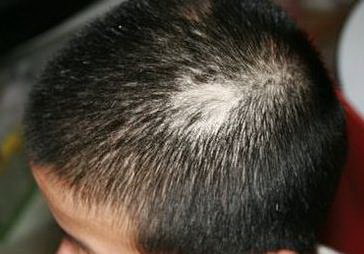 怎么诊治遗传性脱发？