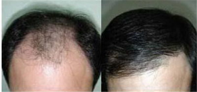 治疗脱发的最好办法全面对抗秃头【治疗脱发的最好办法】