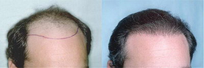 如何治疗女性脱发和生发[如何治疗女性脱发和防脱]