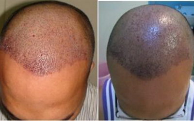 脱发严重有哪些方法治疗_造成严重脱发的原因有哪些
