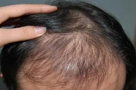 怎样可以治疗遗传性的脱发呢？