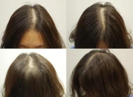 防止化疗脱发的方法「怎样防止化疗脱发方法」