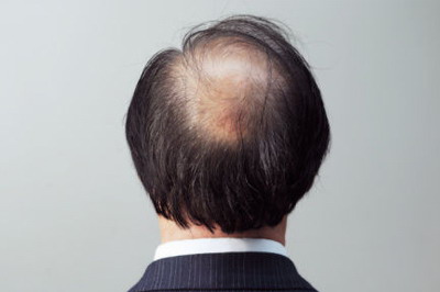 脱发严重有哪些方法治疗_造成严重脱发的原因有哪些