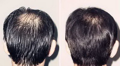 防止男性脱发(预防男性脱发的方法)