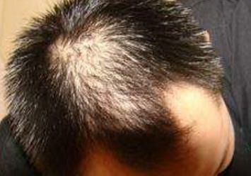 治疗遗传性脱发需要做哪些检查