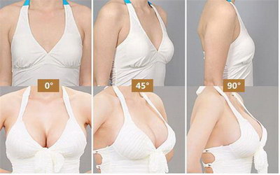 乳房再造用自体脂肪好还是假体好