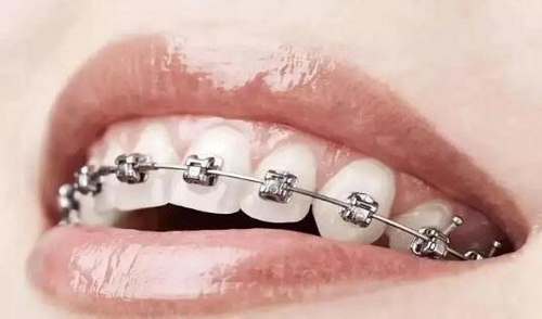 双氧水美白牙齿吗(什么是双氧水美白牙齿？)