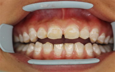 女性牙黄是什么原因